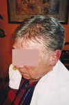 Older man with partial
