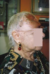 Client; post surgery, where the frontal part of her cranium has been removed
